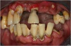 Rotten Teeth – The Most Common Dental Problem - New Jersey Ortho