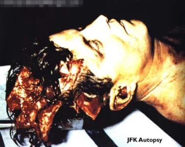 John F. Kennedy autopsy.webp